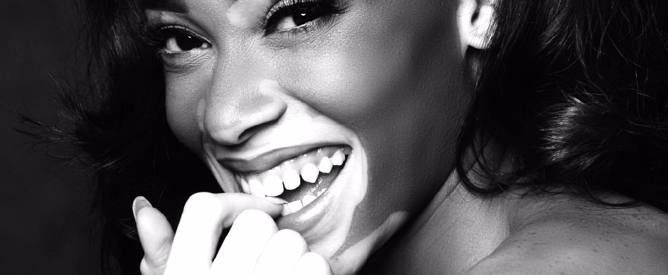 打趴一票女神名模，<白斑女模>做自己紅到不行